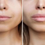 Lip Filler Before