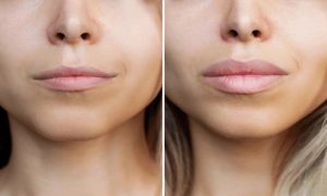 Lip Filler Before