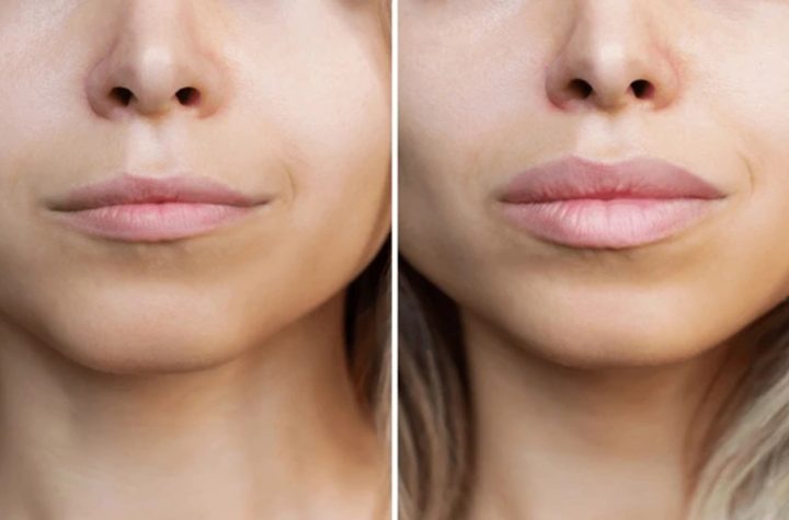 Lip Filler Before